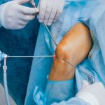 Cirujanos realizando una artroscopia de rodilla