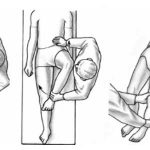 Evaluacion del choque femoroacetabular