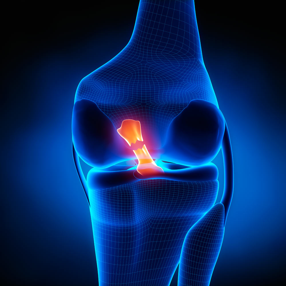 rotura de ligamento cruzado anterior